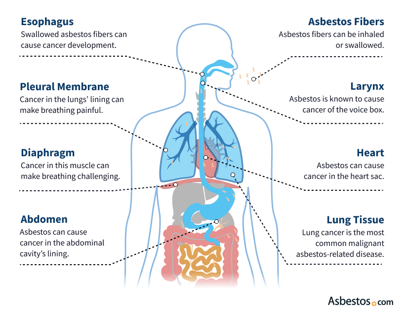 Can A Single Exposure To Asbestos Cause Mesothelioma?