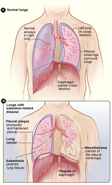 How Do They Check For Asbestos In Lungs?