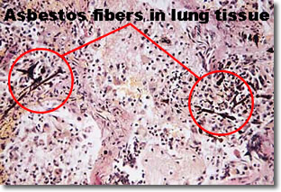 How Do They Check For Asbestos In Lungs?