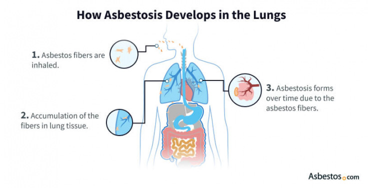 Whats The Meaning Of Asbestosis?